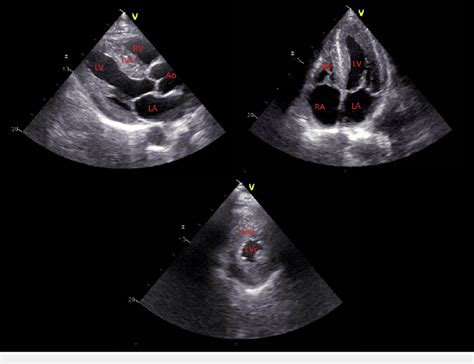 left ventricular enlargement ultrasound